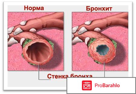 Бронхит реальные отзывы