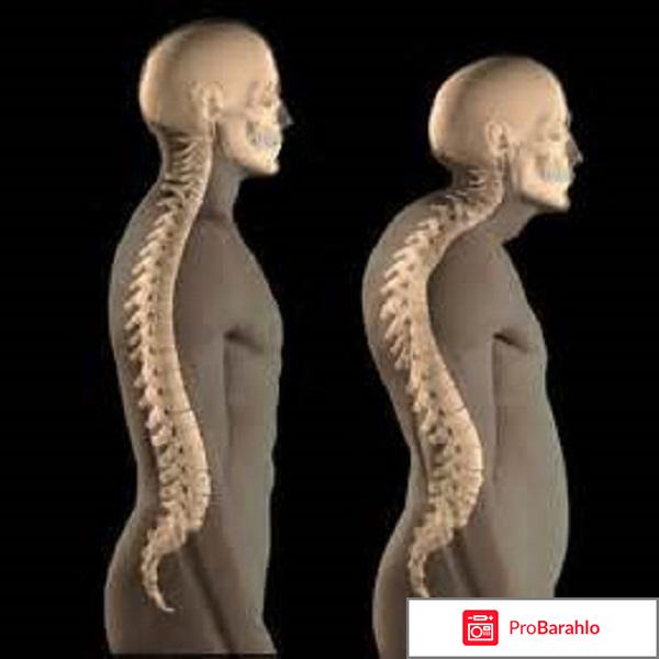 Болезнь шейермана мау код по мкб 10 обман