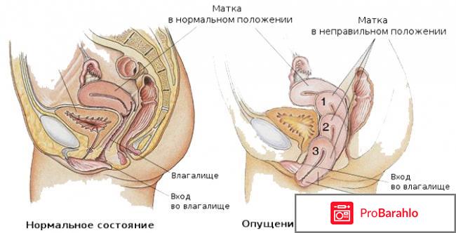 Опущение матки: стадии, причины, лечение отрицательные отзывы