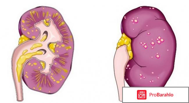 Пиелонефрит лечение народными средствами отзывы 