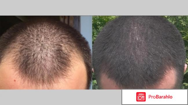 Миноксидил для волос цена обман