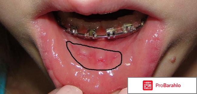 Какие брекеты лучше ставить подростку отзывы отрицательные отзывы