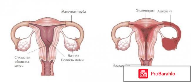 Эндометрит у женщин: виды, симптомы, лечение отрицательные отзывы