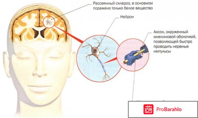 Методы лечения рассеянного склероза 