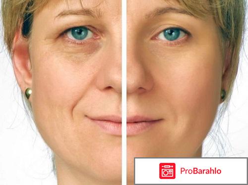 Rf лифтинг лица обман