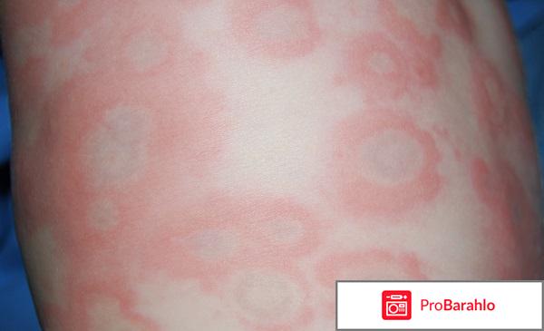 Хроническая идиопатическая крапивница — Причины обман