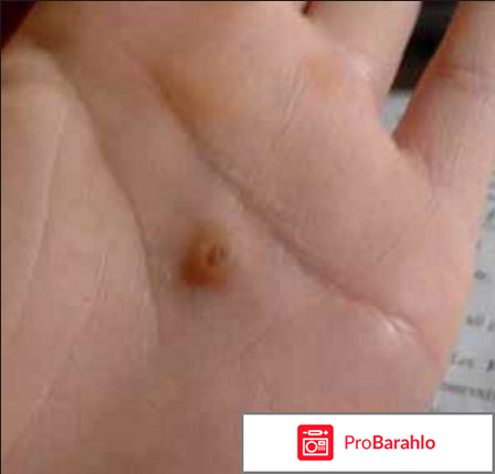 Клареол лекарство от папиллом цена аналоги 