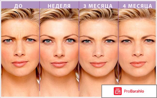 Ботулотоксин цена в аптеке обман