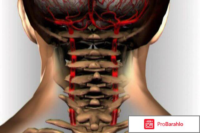 Гипоплазия позвоночной артерии обман