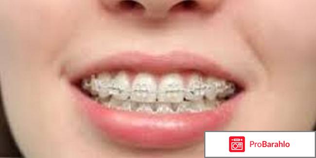 Самолигирующиеся брекеты 