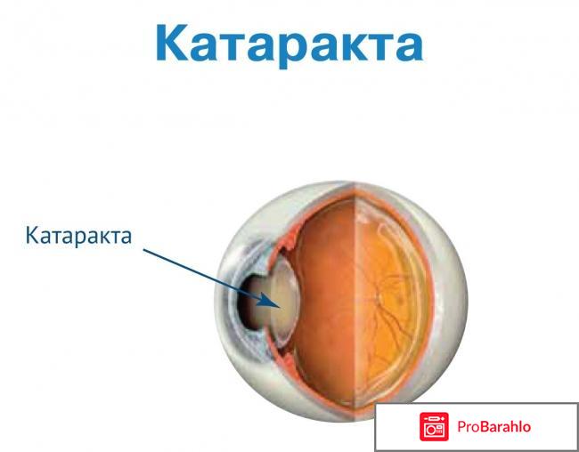 Катаракта операция отрицательные отзывы