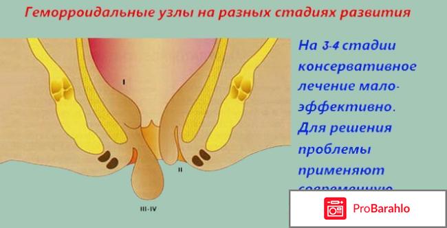 Проктоседил мазь цена отзывы и эффективность 