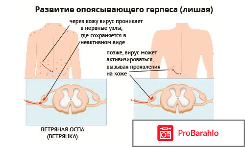 Опоясывающий лишай отзывы людей 