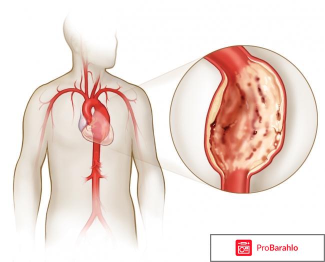 Аневризма аорты сердца что это такое отрицательные отзывы
