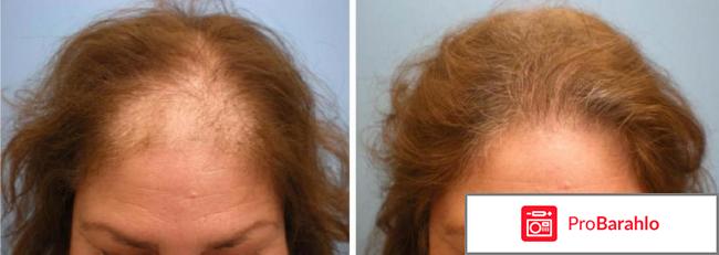 Minoxidil для волос отзывы отрицательные отзывы