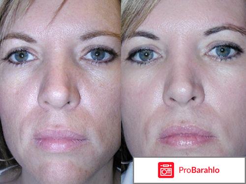 Карбоновый пилинг отзывы 