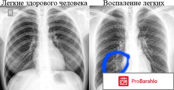 Воспаление легких отрицательные отзывы