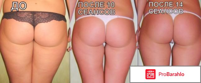 Липолитики от целлюлита обман