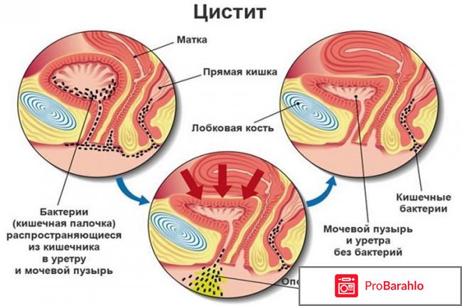 Секстафаг при цистите отрицательные отзывы