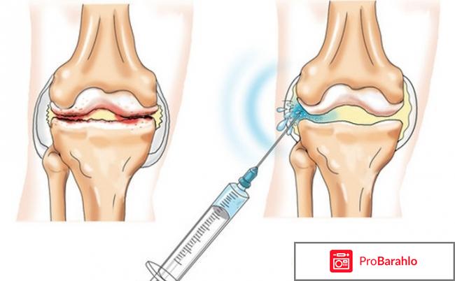 Синвиск отзывы пациентов отрицательные отзывы