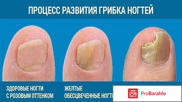 Лечение грибка уксусом реальные отзывы