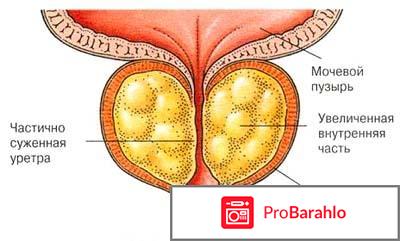 Лечение простатита у мужчин лекарства отзывы отрицательные отзывы