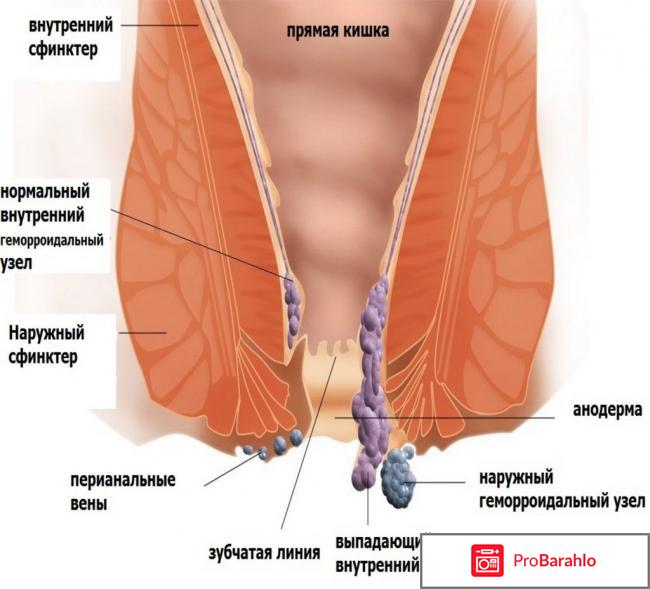 Варикоз прямой кишки и его лечение обман
