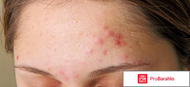 Циновит крем обман