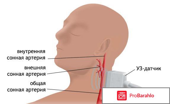 Узи брахиоцефальных сосудов что это отрицательные отзывы