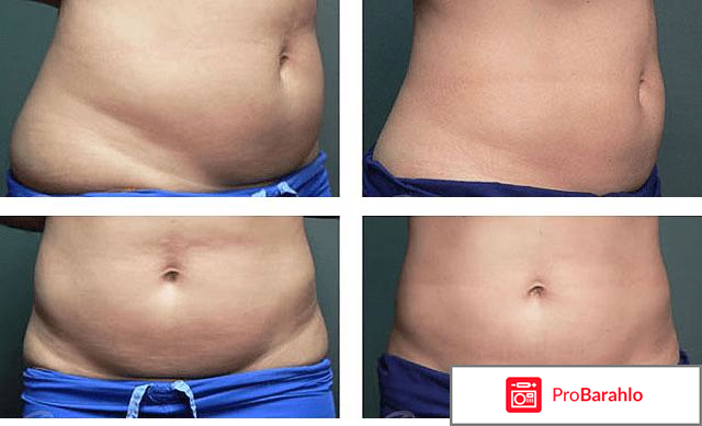 Инъекции для похудения отзывы отзывы владельцев