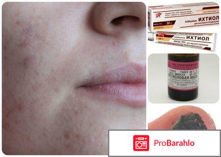 Ихтиоловая мазь от прыщей: польза, противопоказания обман