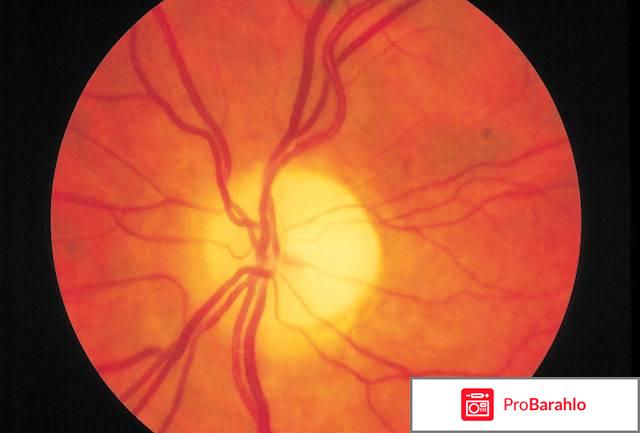 Атрофия глазного нерва лечение и прогноз отрицательные отзывы