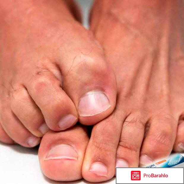 Гель против грибка Экзолоцин отрицательные отзывы