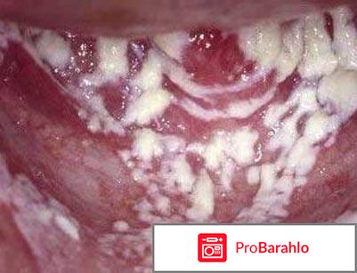 Народные средства от молочницы у женщин отзывы обман