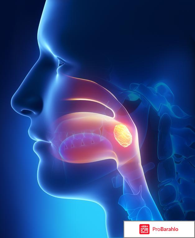 Острый тонзиллит: виды, симптомы, лечение, осложнения обман