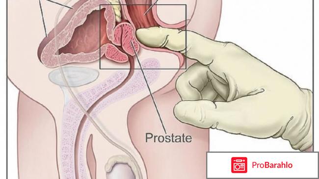 Predstavit (Представит) для лечения простатита отрицательные отзывы