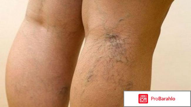 Варикобустер - крем от варикоза, можно ли купить обман