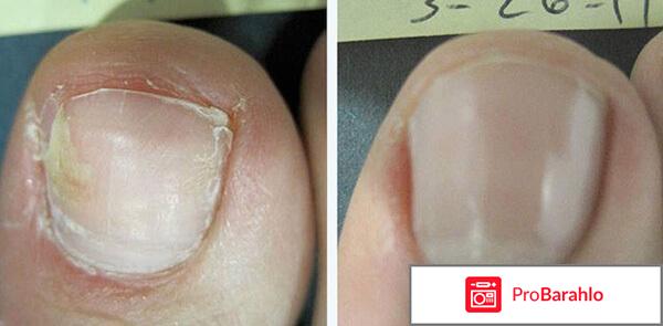 Clean Forte от грибка ногтей и стоп: цена, отзывы, купить реальные отзывы