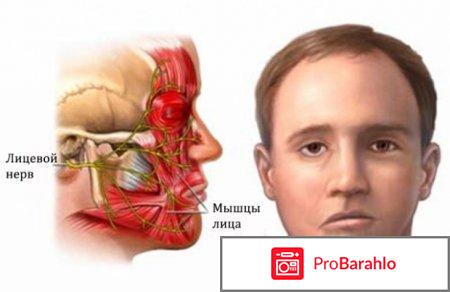 Неврит лицевого нерва 