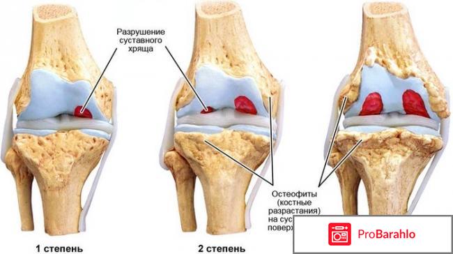 Артроз 1 степени 