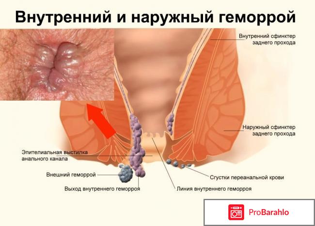 Чем лечить геморрой у женщин отзывы 