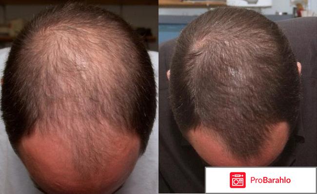 Миноксидил (Minoxidil) фото