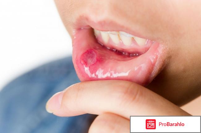 Стоматит: лечение у взрослых, фото, чем и как лечить 