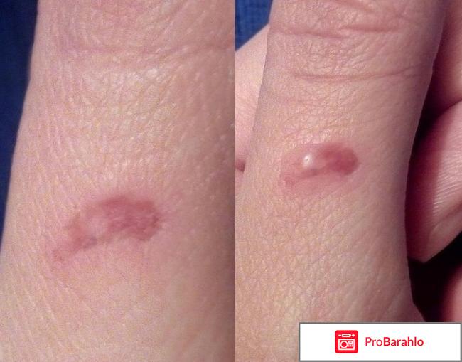 Мазь Солкосерил инструкция 