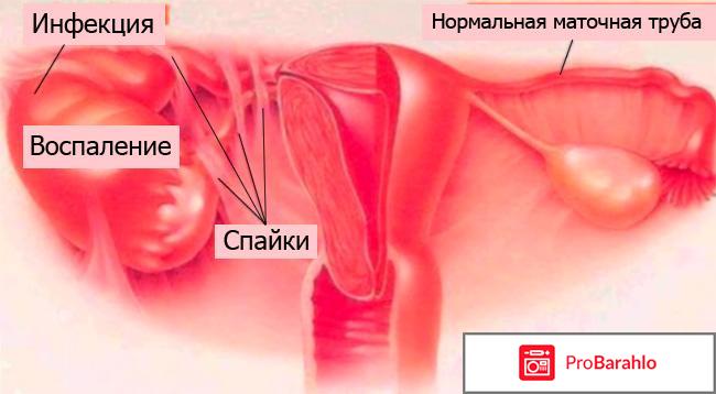 Спайки в трубах 