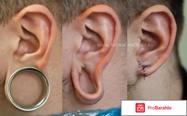 Тоннели в ушах отрицательные отзывы