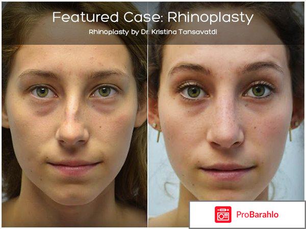 Ринопластика носа отзывы обман