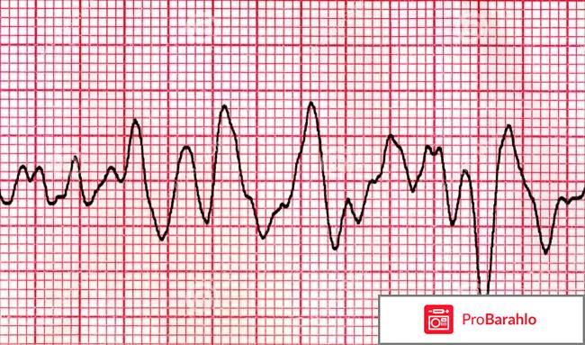 Тахикардия обман