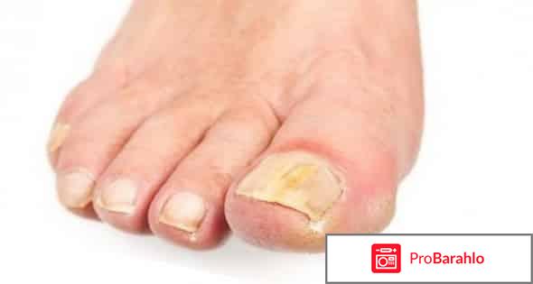 Грибок ногтей лечение препараты недорогие но эффективные 