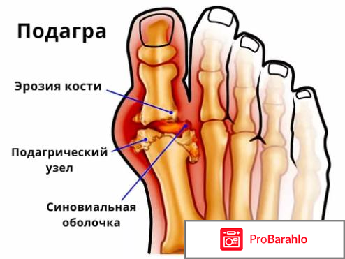 Какие препараты выводят мочевую кислоту из организма отрицательные отзывы